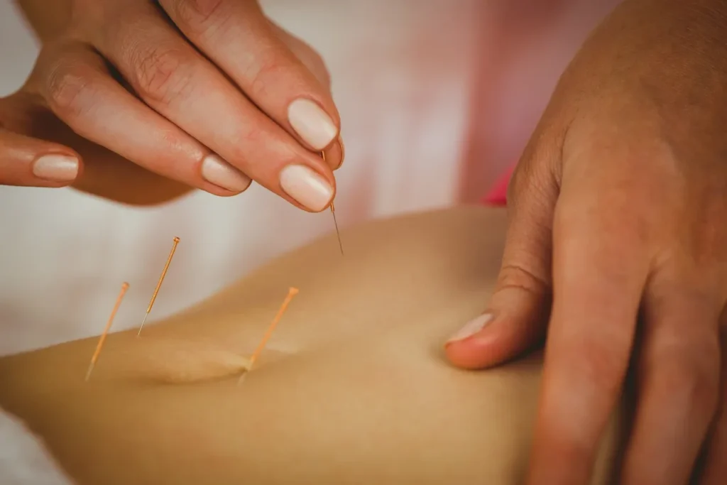 Acupuncture - needle - Acupuncture