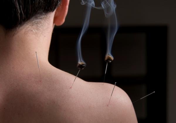 Woman having Moxibustion - Moxibustion