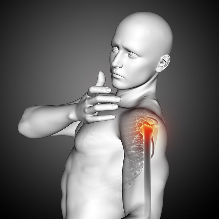 Shoulder pain - Pain relief - Acupuncture